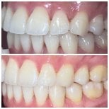Результаты до и после Invisalign в Dentist at home Clinic, Чонбури – ровные зубы