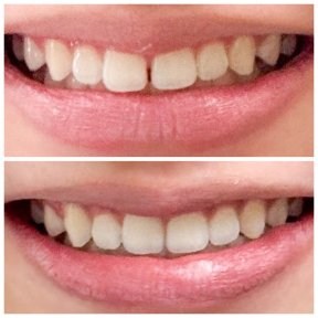 Invisalign before and after results at Dentist at home Clinic, Chonburi – straighter teeth