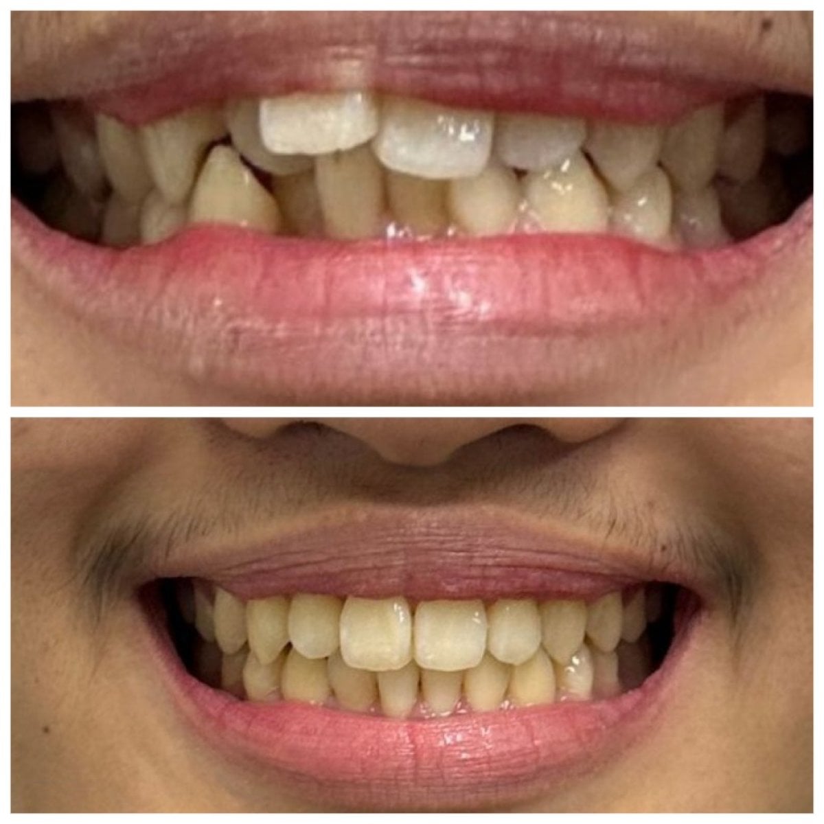 Resultados antes y después de Invisalign en Dentist at home, Bangkok – dientes más rectos