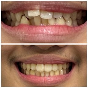 Результаты до и после Invisalign в Dentist at home, Бангкок – ровное выравнивание зубов