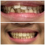 Результаты до и после Invisalign в Dentist at home, Бангкок – ровное выравнивание зубов