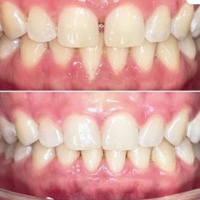 Результаты до и после Invisalign в Dentist at home, Бангкок – ровное выравнивание зубов