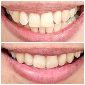 Before and after Invisalign results at Dentist at home Clinic, Chonburi – straighter teeth