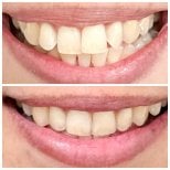 Before and after Invisalign results at Dentist at home Clinic, Chonburi – straighter teeth