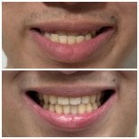Before and after Invisalign results at Dentist at home Clinic, Chonburi, straighter teeth