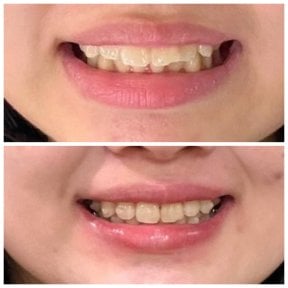 Результаты до и после Invisalign в Dentist at home Clinic, Чонбури – ровные зубы