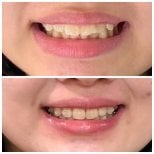 Результаты до и после Invisalign в Dentist at home Clinic, Чонбури – ровные зубы