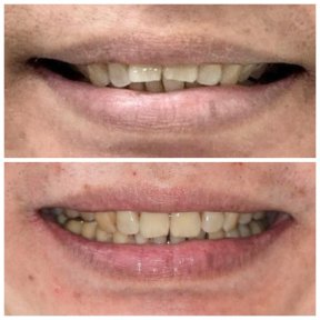 Before and after Invisalign results at Dentist at home Clinic, Chonburi – straighter teeth