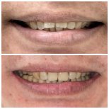 Before and after Invisalign results at Dentist at home Clinic, Chonburi – straighter teeth