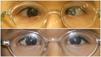 Before and after strabismus surgery results, improved eye alignment in child patient