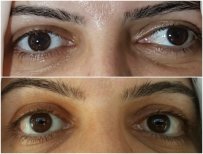 Before and after strabismus surgery results – improved eye alignment and appearance