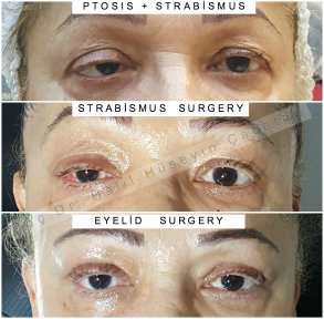 Before and after strabismus and eyelid surgery results, improved eye alignment and eyelids