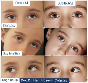 Before and after strabismus surgery results, improved eye alignment by Dr. Halil Hüseyin Çağatay