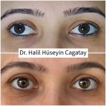 Before and after strabismus surgery results by Dr. Halil Hüseyin Cagatay, eye alignment improved