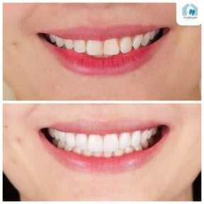 Before and after veneers result at Dentist at home Clinic, Chonburi – smile transformation