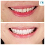 Before and after veneers result at Dentist at home Clinic, Chonburi – smile transformation