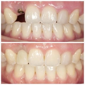 Résultats avant et après implant dentaire à Dentist at home Clinic, Chonburi – sourire restauré