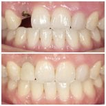 Résultats avant et après implant dentaire à Dentist at home Clinic, Chonburi – sourire restauré
