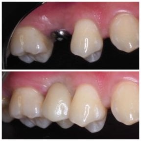Before and after dental implant result at Dentist at home Clinic, Chonburi, restored tooth