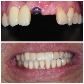 Before and after dental implant results at Dentist at home Clinic, Chonburi – restored smile