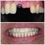 Before and after dental implant results at Dentist at home Clinic, Chonburi – restored smile