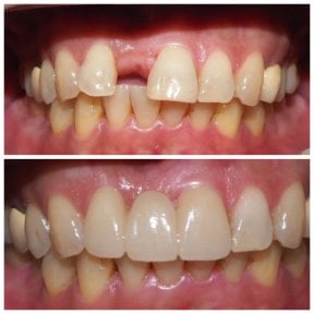 Before and after dental implant results at Dentist at home Clinic, Chonburi, restored smile
