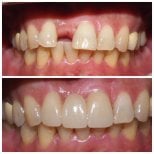 Before and after dental implant results at Dentist at home Clinic, Chonburi, restored smile