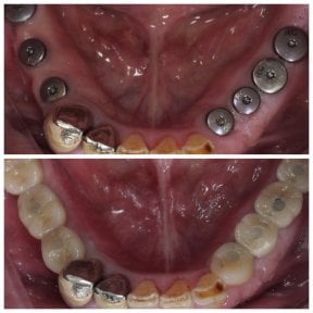 Résultats avant et après implants dentaires à Dentist at home Clinic, Chonburi – dents inférieures restaurées