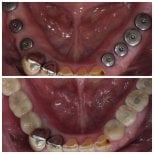 Résultats avant et après implants dentaires à Dentist at home Clinic, Chonburi – dents inférieures restaurées
