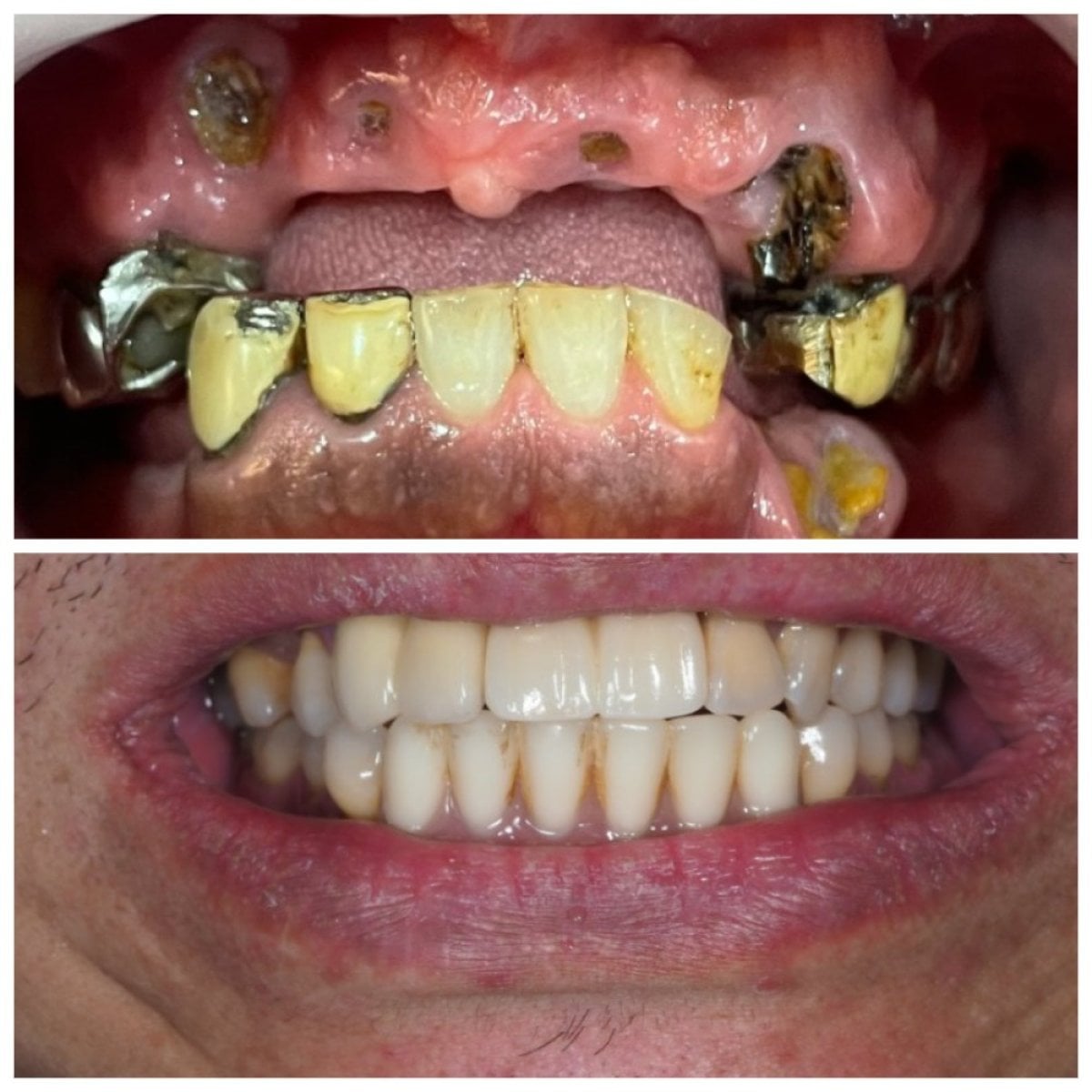 Resultados antes y después de implantes All-on-4 en Dentist at home Clinic, Chonburi