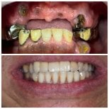 Before and after All-on-4 dental implants result at Dentist at home Clinic, Chonburi