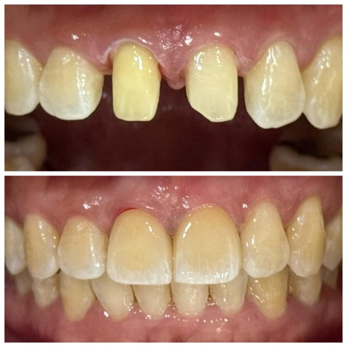 Resultados antes y después de coronas dentales en Dentist at home Clinic, Chonburi