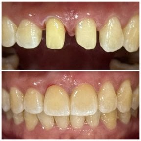 Résultats avant et après pose de couronnes dentaires à Dentist at home Clinic, Chonburi