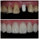 Résultats avant et après la pose de couronnes dentaires à Dentist at home Clinic, Chonburi