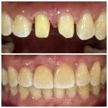 Before and after dental crown installation results at Dentist at home, Bangkok, improved smile