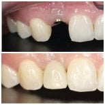Résultats avant et après pose de couronne dentaire à Dentist at home Clinic, Chonburi