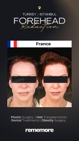 before-after photo forehead-contouring