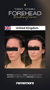 before-after photo forehead-contouring