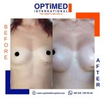 Результаты до и после увеличения груди в Optimed International Hospital, увеличенный объем