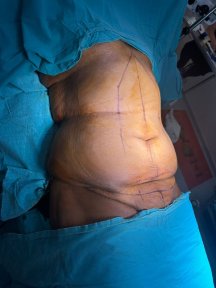 before-after photo liposuction