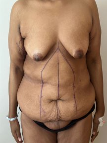 before-after photo liposuction