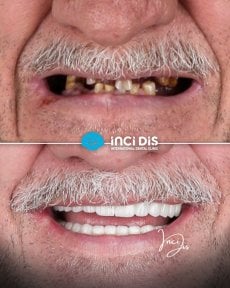 before-after photo all-on-6-dental-implants