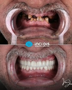 before-after photo all-on-6-dental-implants