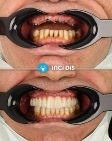 before-after photo all-on-6-dental-implants