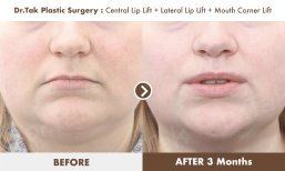 Before and after lip lift results at Dr. Tak Plastic Surgery – enhanced lip contour after 3 months