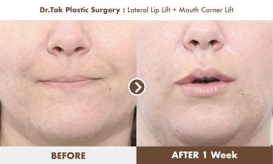 Before and after lip lift and mouth corner lift results at Dr. Tak Plastic Surgery clinic