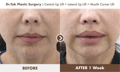 Before and after lip lift results at Dr. Tak Plastic Surgery – enhanced lip shape after 1 week