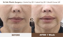 Before and after lip lift results at Dr. Tak Plastic Surgery – enhanced lip shape after 1 week