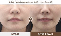 Before and after lip lift and mouth corner lift results at Dr. Tak Plastic Surgery clinic