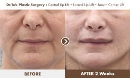 Before and after lip lift results at Dr. Tak Plastic Surgery, visible lip contour improvement